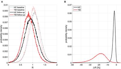 Mild Traumatic Brain Injury Results in Significant and Lasting Cortical Demyelination